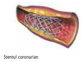 Angina_pectorala_2