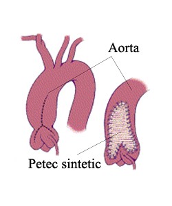 stenozele-aortice3