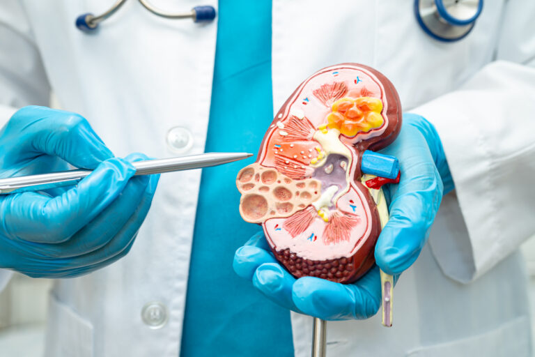 Kidney disease, Chronic kidney disease ckd, Doctor hold human mo
