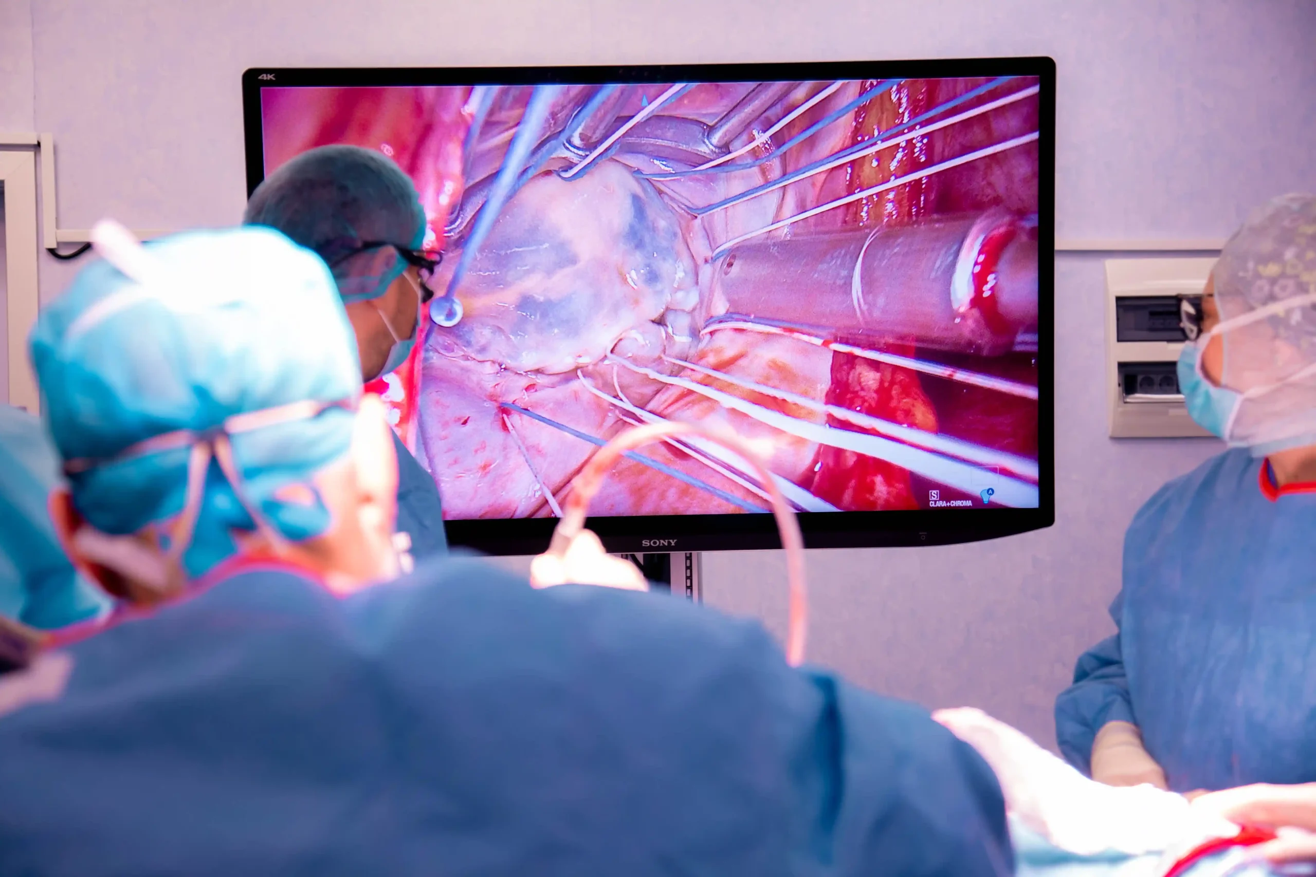 imagine din sala chirurgicala - plastie valvulara partial endoscopica