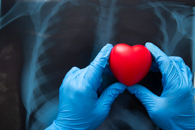 Red heart on x ray chest